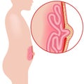 Umbilical hernia. divergence of the abdominal muscles.